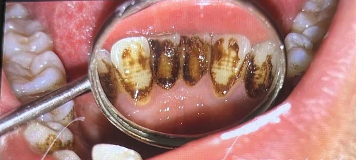 Stain Removal — Scaling & Polishing before