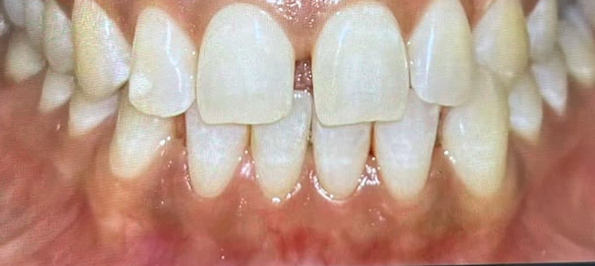 Teeth Whitening after