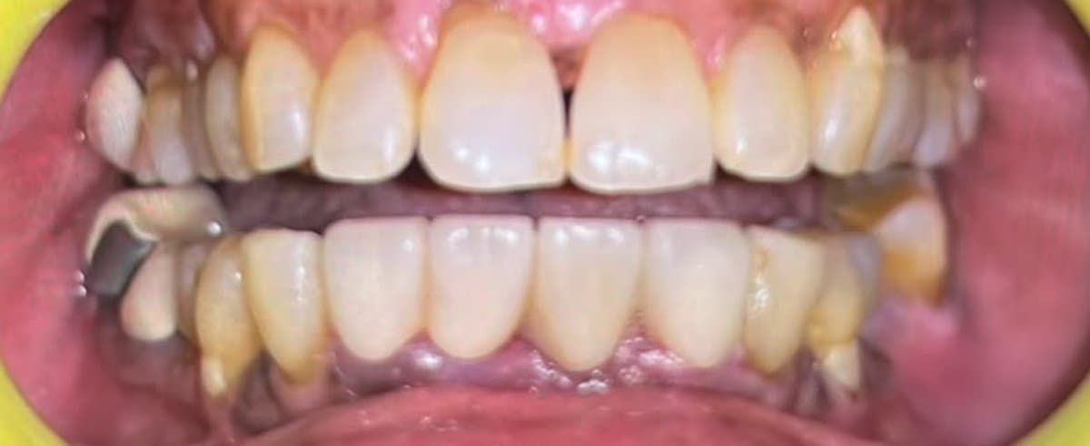 Missing Teeth — Zirconia Bridge after