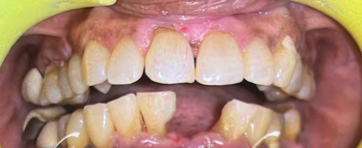 Missing Teeth — Zirconia Bridge before