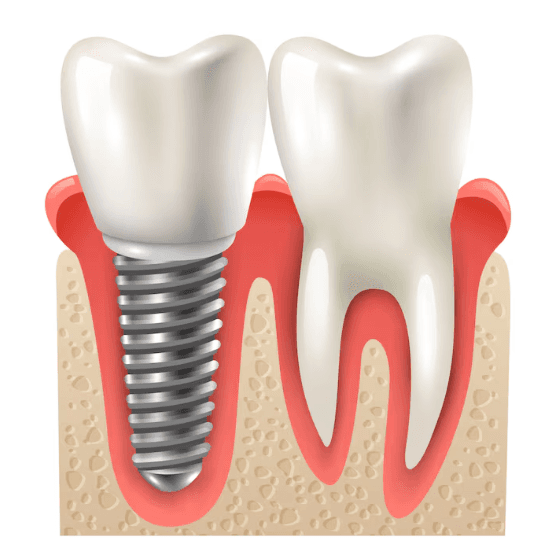 Dental Implants