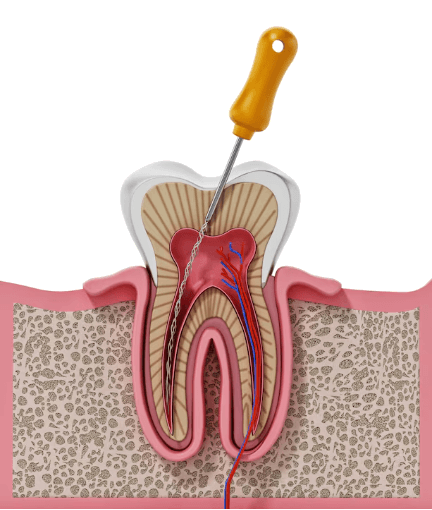Root Canal Treatment