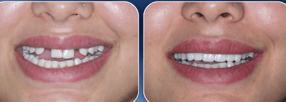 Smile Makeover